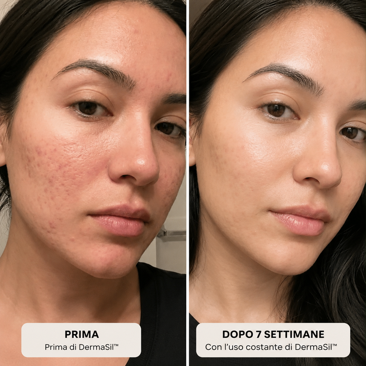 DermaSil™ | Stick al Silicone per Cicatrici da Acne e Pelle Irregolare